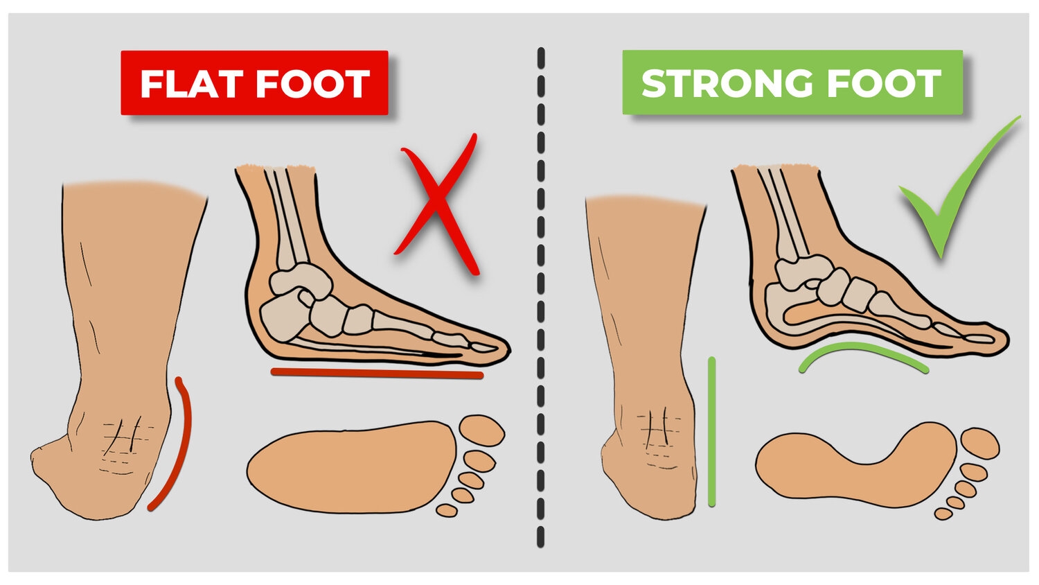 Flat+foot+vs+Strong+foot+